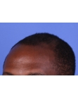Before Hair Transplant&nbsp;Front